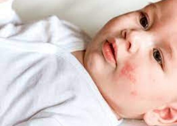 شایع ترین انواع حساسیت پوستی کودکان و نوزادان