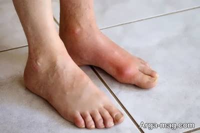 نقرس عاملی برای شروع درمان درد انگشتان پا