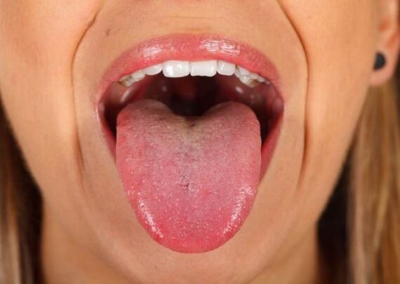 روش های رایج درمان زردی زبان