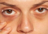 آشنایی با موثرترین روش های برای درمان تیرگی دور چشم