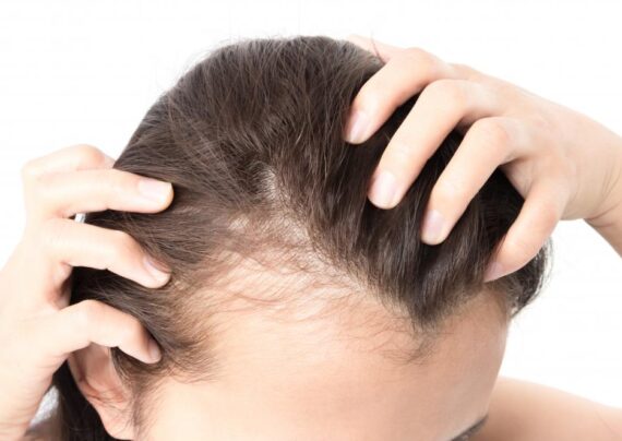 روش های درمان ریزش موی جلوی سر
