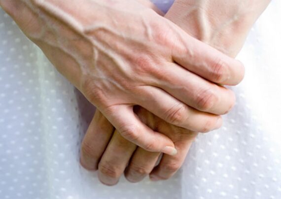 درمان بیرون زدگی رگ های دست با روش های خانگی