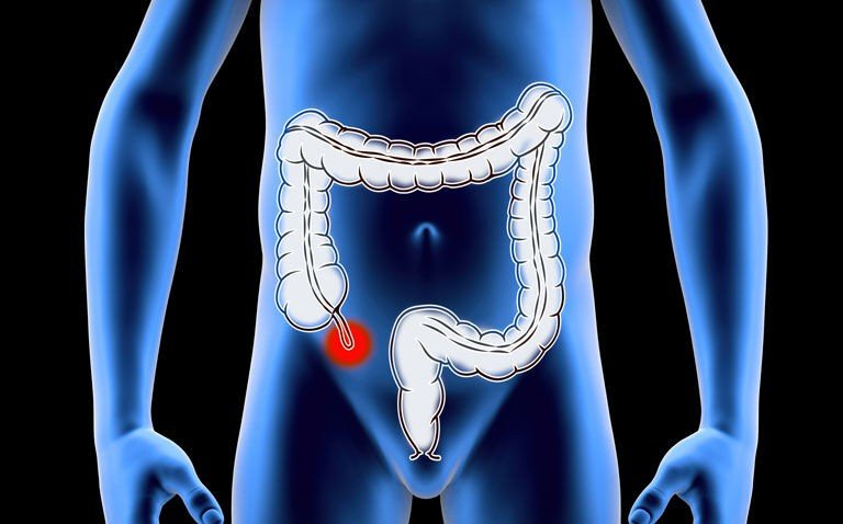 التهاب اپاندیس دختر 2 ساله در اثر بلعیدن پیچ 8 میلی متری!