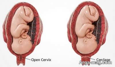 سرکلاژ روشی برای مهار ناتوانی رحم