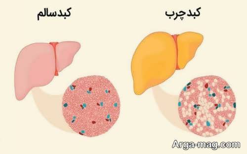 دلایل چرب شدن کبد در سنین کم