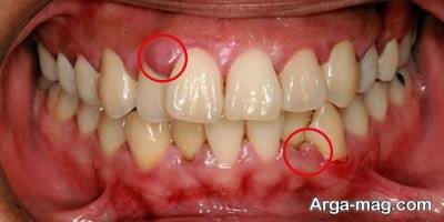 نشانه های تحلیل رفتن لثه