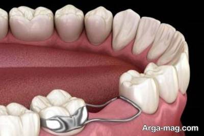 استفاده از روکش دندان برای دندان شیری