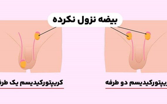 چند درصد نوزادان پسر با بیضه نزول نکرده متولد می شوند؟