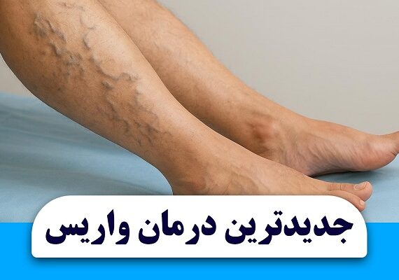 روش درمان واریس