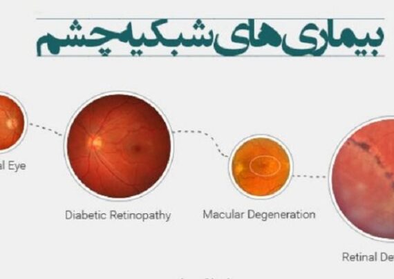 آشنایی با بیماری های شبکیه چشم