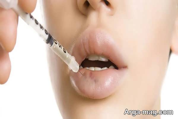 درمان و رفع ورم بعد از تزریق ژل لب