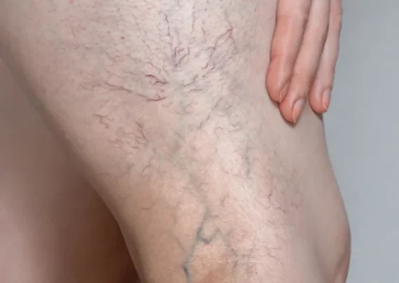 واریس چگونه ایجاد می شود