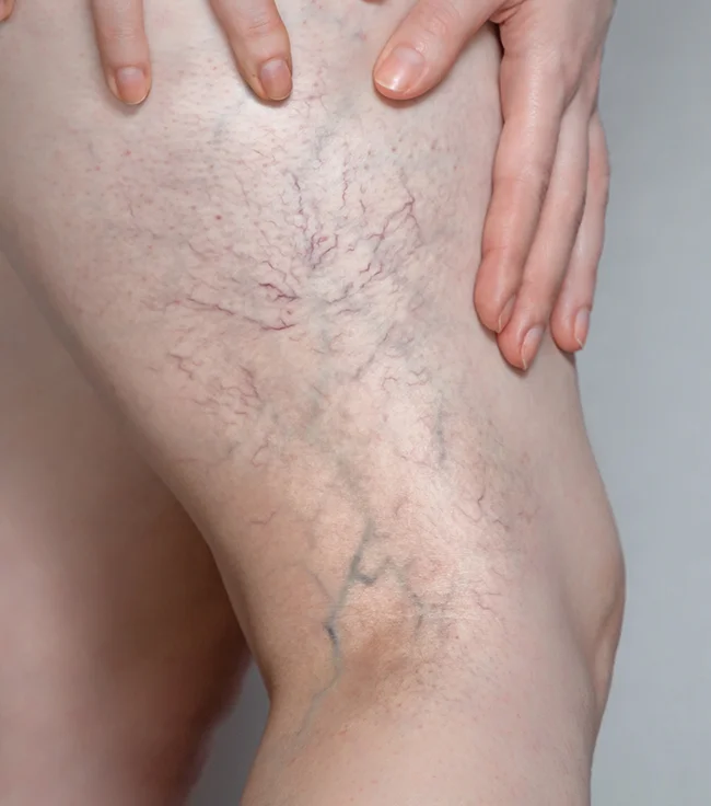 واریس چگونه ایجاد می شود