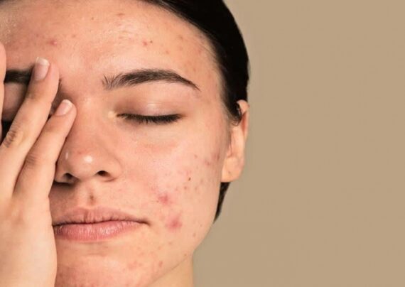تاثیر استرس بر پوست صورت