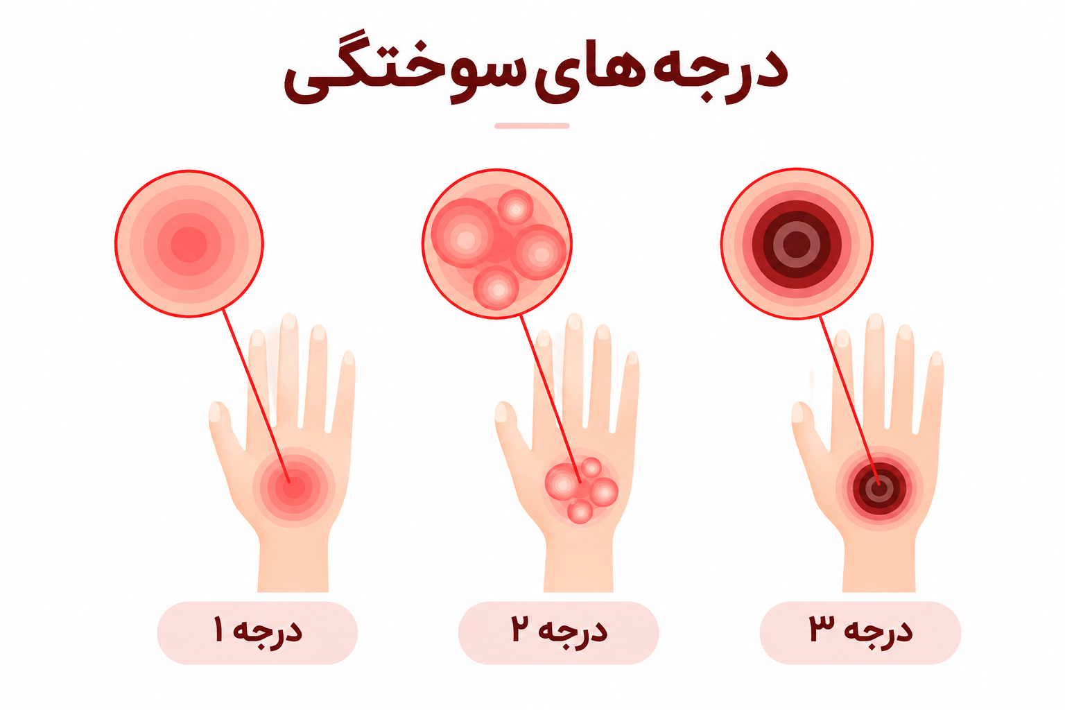 درجه های سوختگی